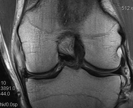 MCL acute grade 3 Femur MRI